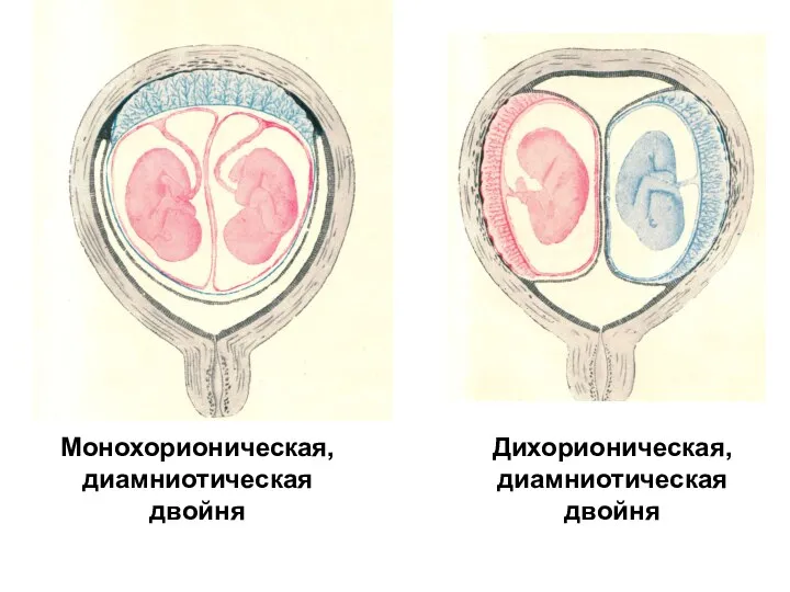 Монохорионическая, диамниотическая двойня Дихорионическая, диамниотическая двойня