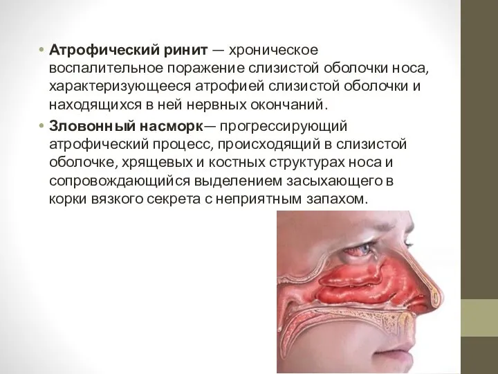 Атрофический ринит — хроническое воспалительное поражение слизистой оболочки носа, характеризующееся атрофией