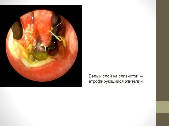 Белый слой на слизистой — атрофирующийся эпителий.