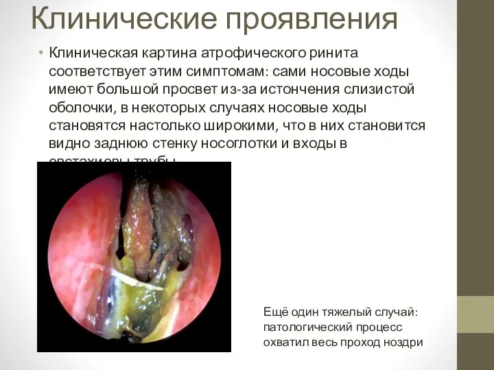 Клинические проявления Клиническая картина атрофического ринита соответствует этим симптомам: сами носовые