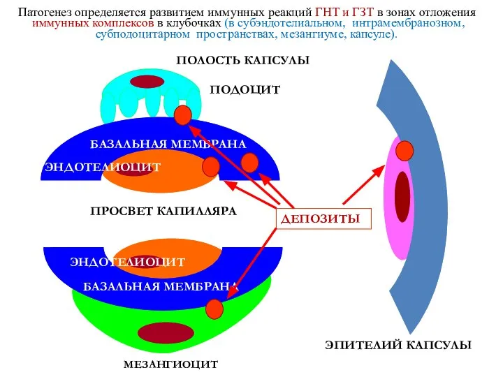 Патогенез определяется развитием иммунных реакций ГНТ и ГЗТ в зонах отложения