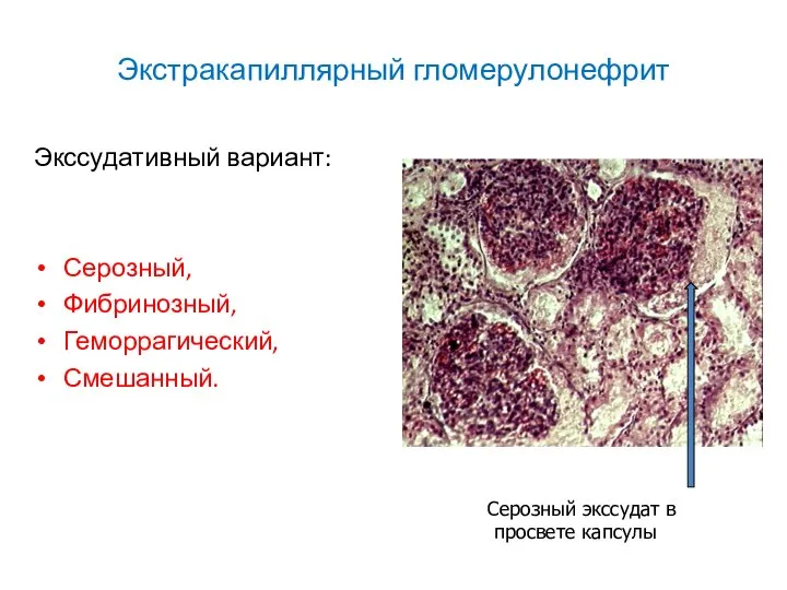 Экстракапиллярный гломерулонефрит Экссудативный вариант: Серозный, Фибринозный, Геморрагический, Смешанный. Серозный экссудат в просвете капсулы