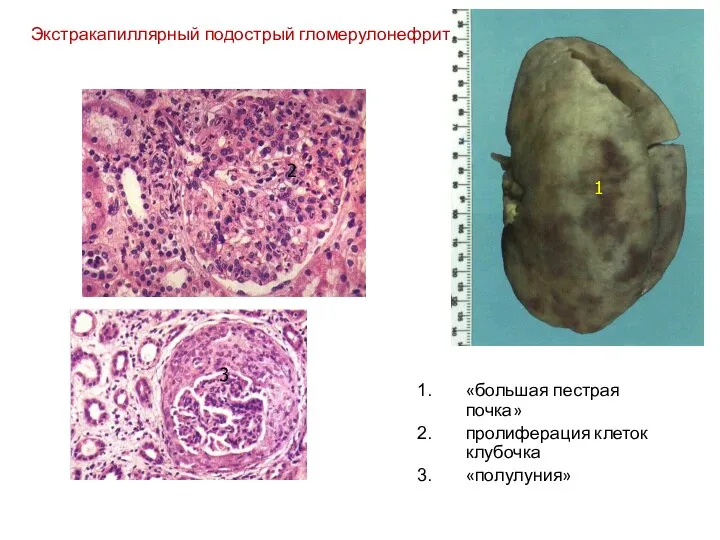 Экстракапиллярный подострый гломерулонефрит «большая пестрая почка» пролиферация клеток клубочка «полулуния» 1 2 3