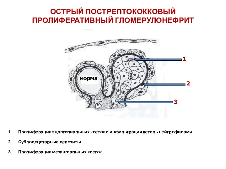 ОСТРЫЙ ПОСТРЕПТОКОККОВЫЙ ПРОЛИФЕРАТИВНЫЙ ГЛОМЕРУЛОНЕФРИТ Пролиферация эндотелиальных клеток и инфильтрация петель нейтрофилами