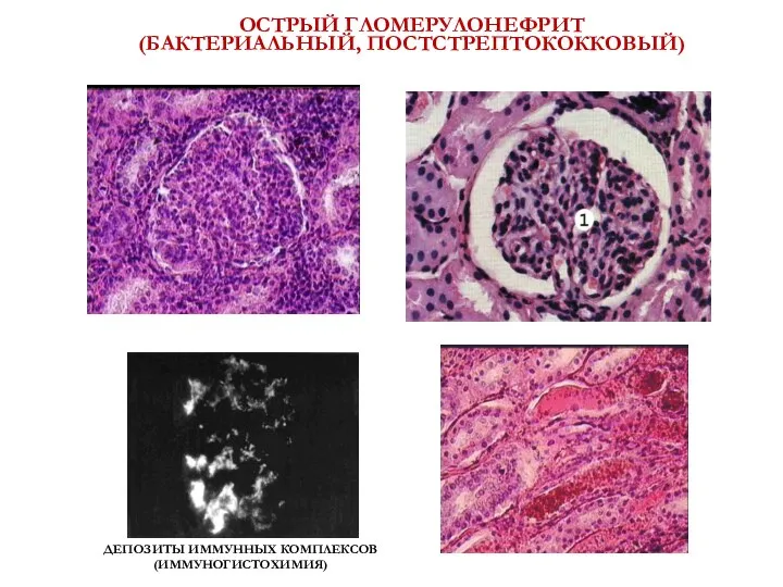 ОСТРЫЙ ГЛОМЕРУЛОНЕФРИТ (БАКТЕРИАЛЬНЫЙ, ПОСТСТРЕПТОКОККОВЫЙ) ДЕПОЗИТЫ ИММУННЫХ КОМПЛЕКСОВ (ИММУНОГИСТОХИМИЯ)