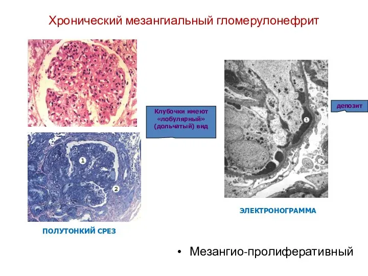 Хронический мезангиальный гломерулонефрит Мезангио-пролиферативный ПОЛУТОНКИЙ СРЕЗ ЭЛЕКТРОНОГРАММА Клубочки имеют «лобулярный» (дольчатый) вид депозит