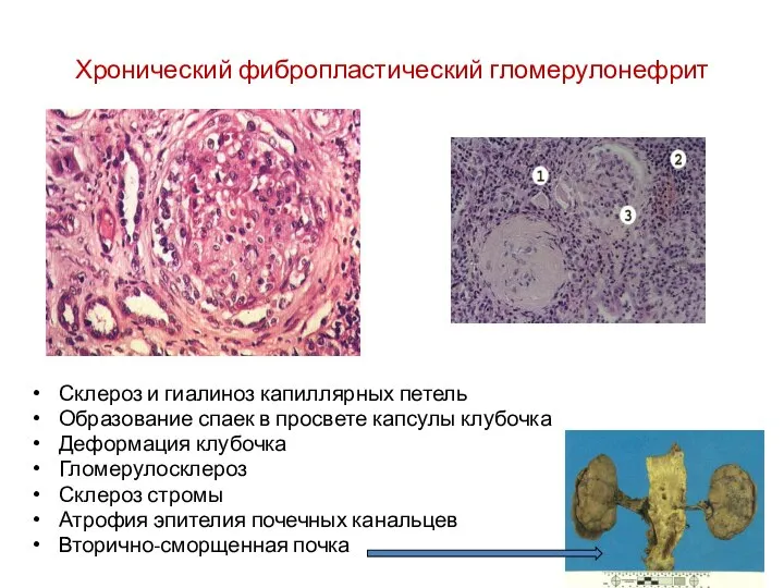 Хронический фибропластический гломерулонефрит Склероз и гиалиноз капиллярных петель Образование спаек в