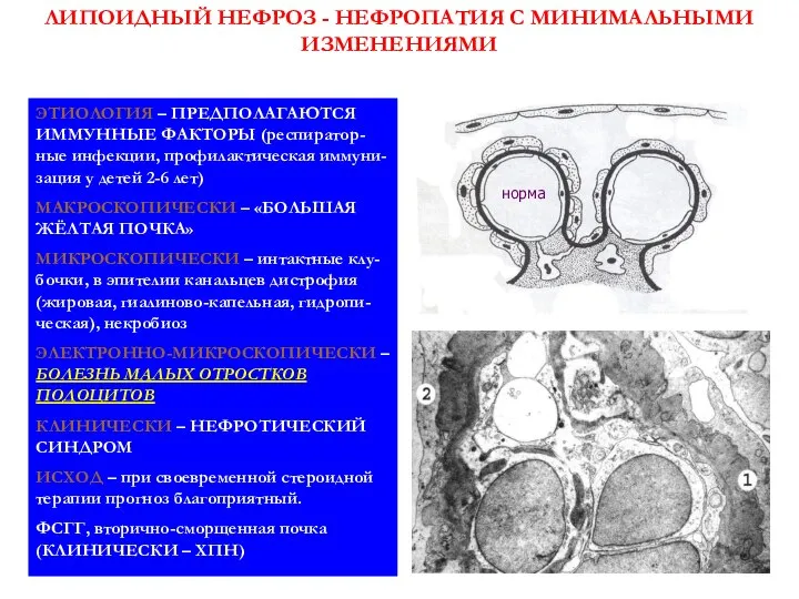 ЛИПОИДНЫЙ НЕФРОЗ - НЕФРОПАТИЯ С МИНИМАЛЬНЫМИ ИЗМЕНЕНИЯМИ ЭТИОЛОГИЯ – ПРЕДПОЛАГАЮТСЯ ИММУННЫЕ