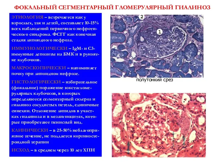 ФОКАЛЬНЫЙ СЕГМЕНТАРНЫЙ ГЛОМЕРУЛЯРНЫЙ ГИАЛИНОЗ ЭТИОЛОГИЯ – встречается как у взрослых, так