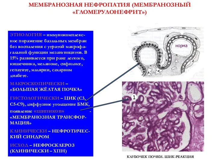 МЕМБРАНОЗНАЯ НЕФРОПАТИЯ (МЕМБРАНОЗНЫЙ «ГЛОМЕРУЛОНЕФРИТ») ЭТИОЛОГИЯ – иммунокомплекс-ное поражение базальных мембран без