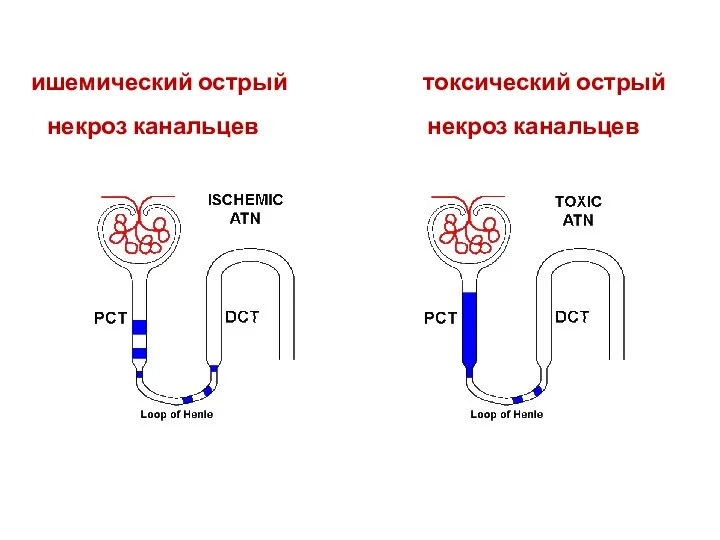 ишемический острый токсический острый некроз канальцев некроз канальцев