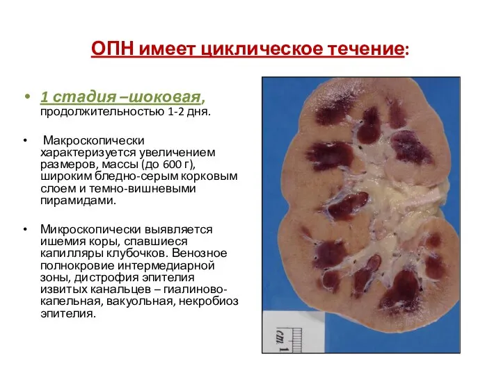 ОПН имеет циклическое течение: 1 стадия –шоковая, продолжительностью 1-2 дня. Макроскопически