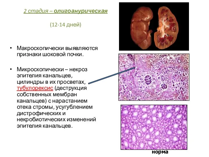 2 стадия – олигоанурическая (12-14 дней) Макроскопически выявляются признаки шоковой почки.