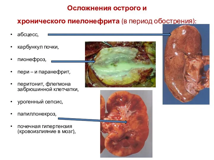 Осложнения острого и хронического пиелонефрита (в период обострения): абсцесс, карбункул почки,