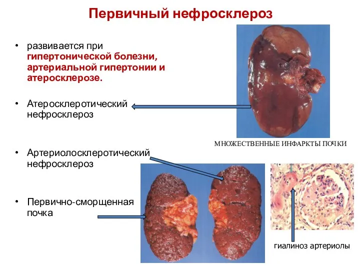 Первичный нефросклероз развивается при гипертонической болезни, артериальной гипертонии и атеросклерозе. Атеросклеротический
