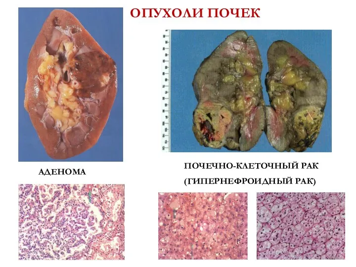 ОПУХОЛИ ПОЧЕК АДЕНОМА ПОЧЕЧНО-КЛЕТОЧНЫЙ РАК (ГИПЕРНЕФРОИДНЫЙ РАК)