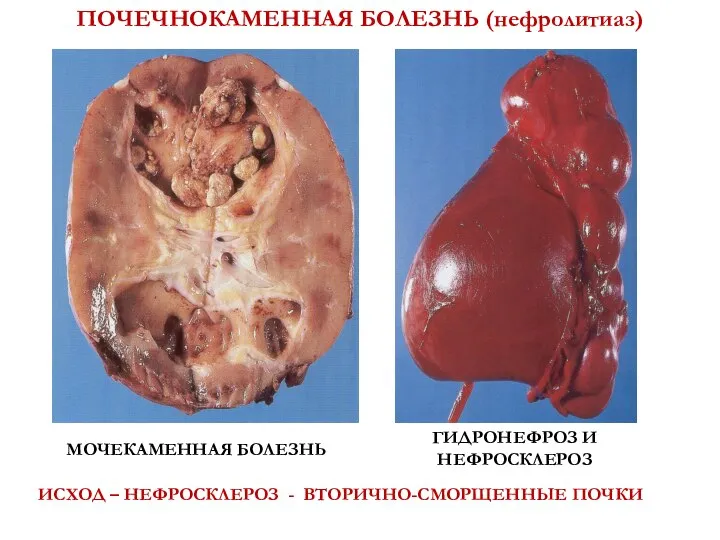 ПОЧЕЧНОКАМЕННАЯ БОЛЕЗНЬ (нефролитиаз) МОЧЕКАМЕННАЯ БОЛЕЗНЬ ГИДРОНЕФРОЗ И НЕФРОСКЛЕРОЗ ИСХОД – НЕФРОСКЛЕРОЗ - ВТОРИЧНО-СМОРЩЕННЫЕ ПОЧКИ