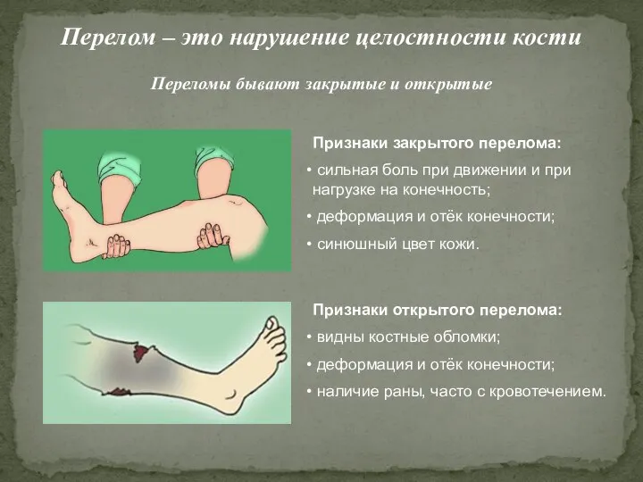 Перелом – это нарушение целостности кости Переломы бывают закрытые и открытые