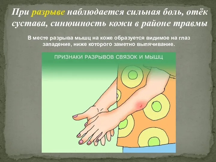 При разрыве наблюдается сильная боль, отёк сустава, синюшность кожи в районе