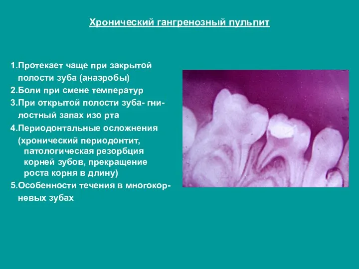 Хронический гангренозный пульпит 1.Протекает чаще при закрытой полости зуба (анаэробы) 2.Боли