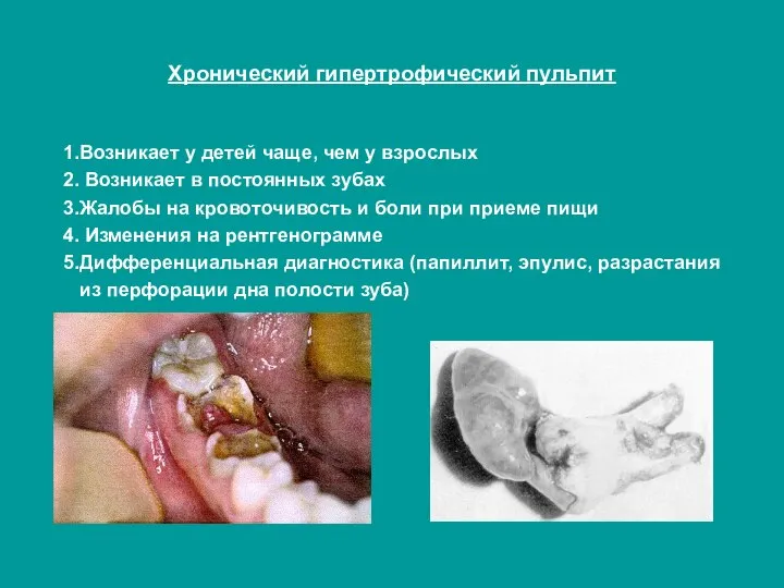 Хронический гипертрофический пульпит 1.Возникает у детей чаще, чем у взрослых 2.