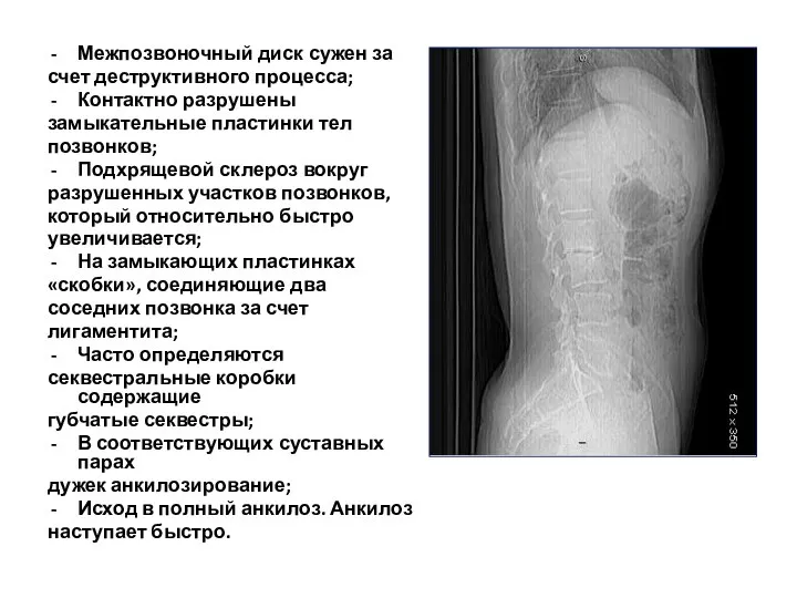 Межпозвоночный диск сужен за счет деструктивного процесса; Контактно разрушены замыкательные пластинки