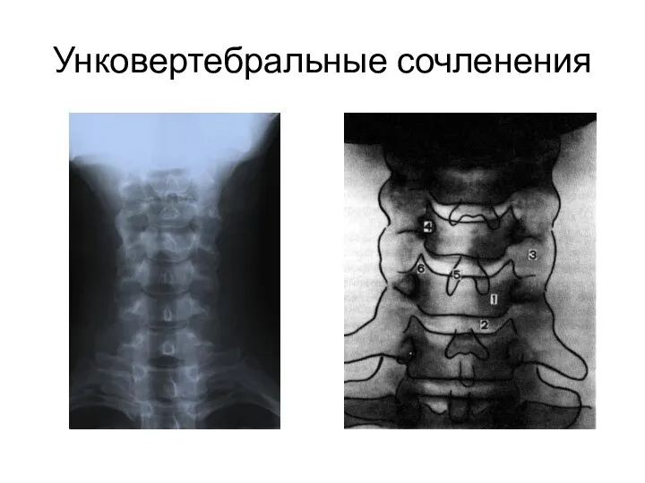 Унковертебральные сочленения