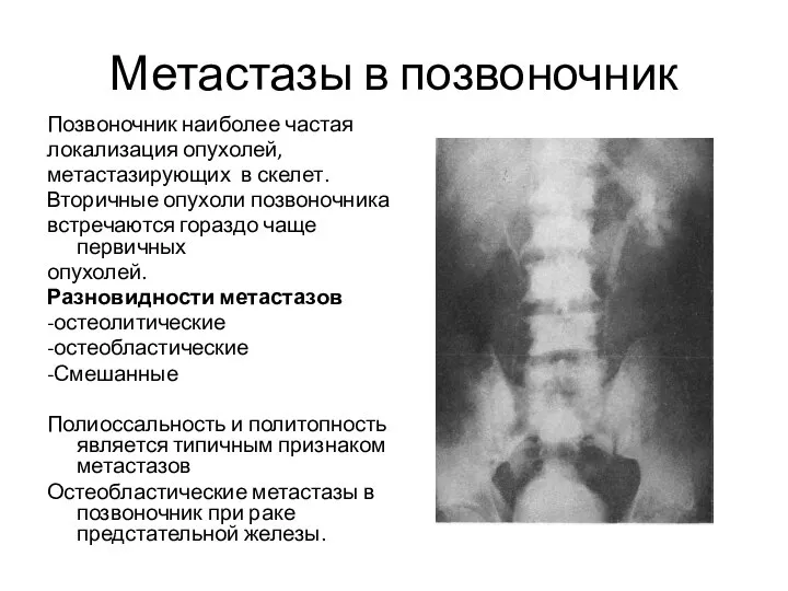 Метастазы в позвоночник Позвоночник наиболее частая локализация опухолей, метастазирующих в скелет.