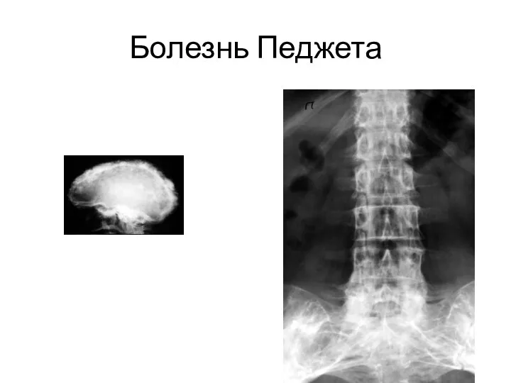 Болезнь Педжета