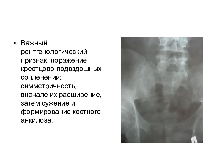 Важный рентгенологический признак- поражение крестцово-подвздошных сочленений: симметричность, вначале их расширение, затем сужение и формирование костного анкилоза.