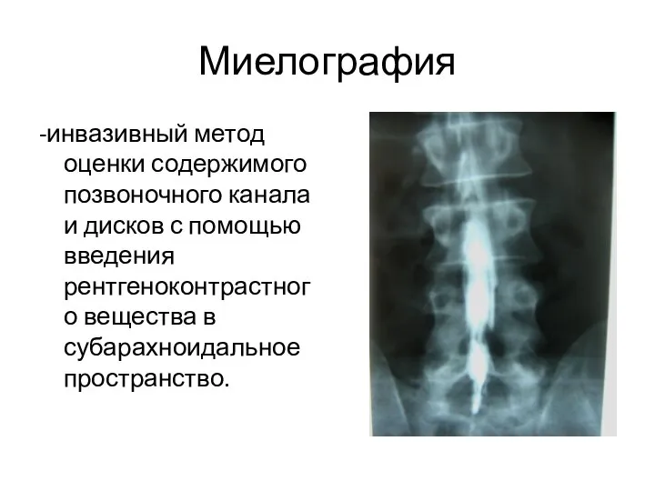 Миелография -инвазивный метод оценки содержимого позвоночного канала и дисков с помощью