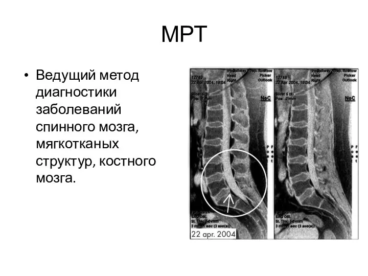 МРТ Ведущий метод диагностики заболеваний спинного мозга, мягкотканых структур, костного мозга.