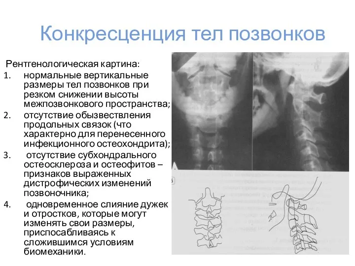 Конкресценция тел позвонков Рентгенологическая картина: нормальные вертикальные размеры тел позвонков при