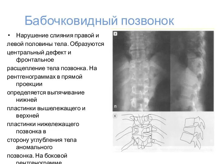 Бабочковидный позвонок Нарушение слияния правой и левой половины тела. Образуются центральный