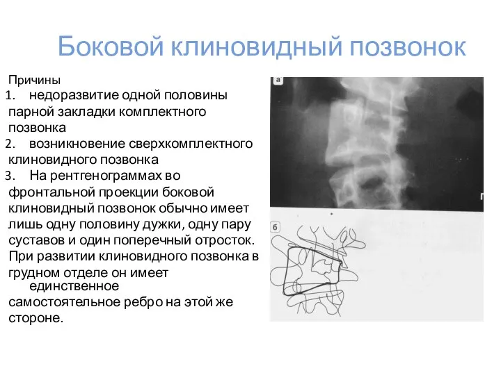 Боковой клиновидный позвонок Причины недоразвитие одной половины парной закладки комплектного позвонка