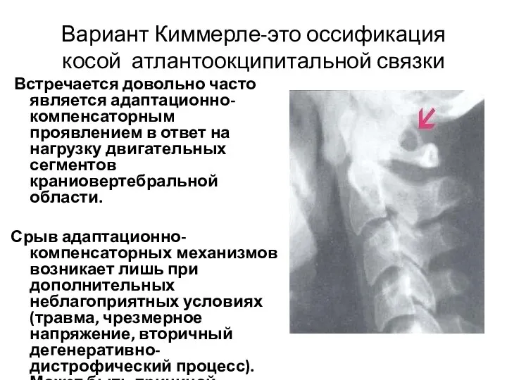 Вариант Киммерле-это оссификация косой атлантоокципитальной связки Встречается довольно часто является адаптационно-компенсаторным