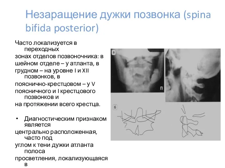 Незаращение дужки позвонка (spina bifida posterior) Часто локализуется в переходных зонах