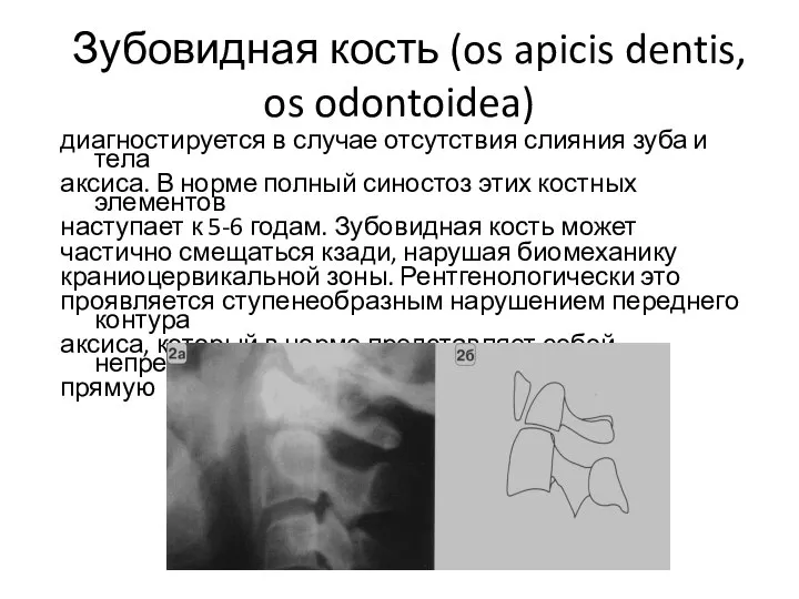 Зубовидная кость (os apicis dentis, os odontoidea) диагностируется в случае отсутствия