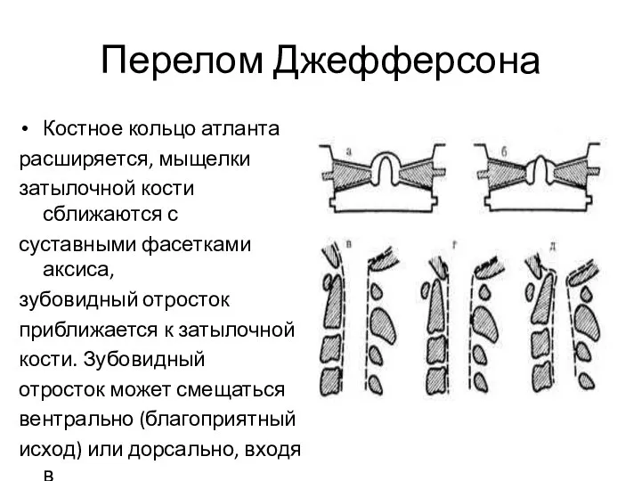 Перелом Джефферсона Костное кольцо атланта расширяется, мыщелки затылочной кости сближаются с