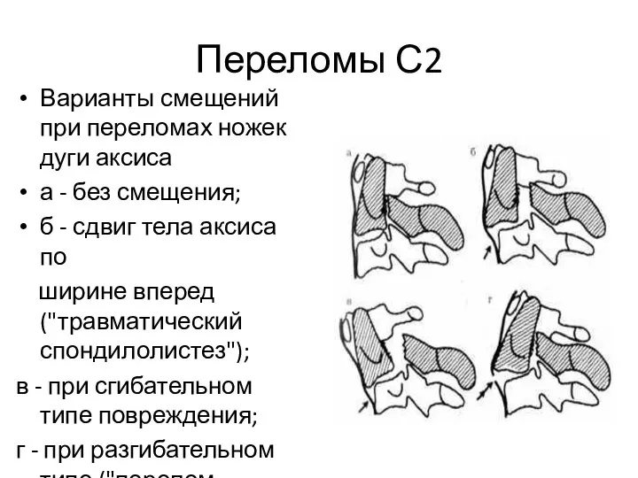 Переломы С2 Варианты смещений при переломах ножек дуги аксиса а -