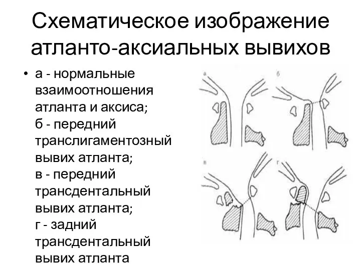 Схематическое изображение атланто-аксиальных вывихов а - нормальные взаимоотношения атланта и аксиса;