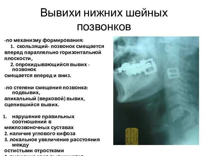 Вывихи нижних шейных позвонков -по механизму формирования: 1. скользящий- позвонок смещается