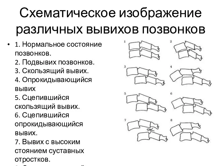 Схематическое изображение различных вывихов позвонков 1. Нормальное состояние позвонков. 2. Подвывих