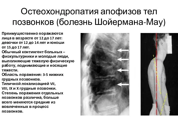 Остеохондропатия апофизов тел позвонков (болезнь Шойермана-Мау) Преимущественно поражаются лица в возрасте