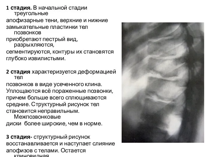 1 стадия. В начальной стадии треугольные апофизарные тени, верхние и нижние