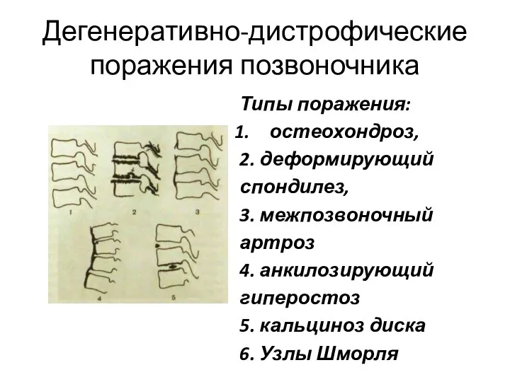 Дегенеративно-дистрофические поражения позвоночника Типы поражения: остеохондроз, 2. деформирующий спондилез, 3. межпозвоночный