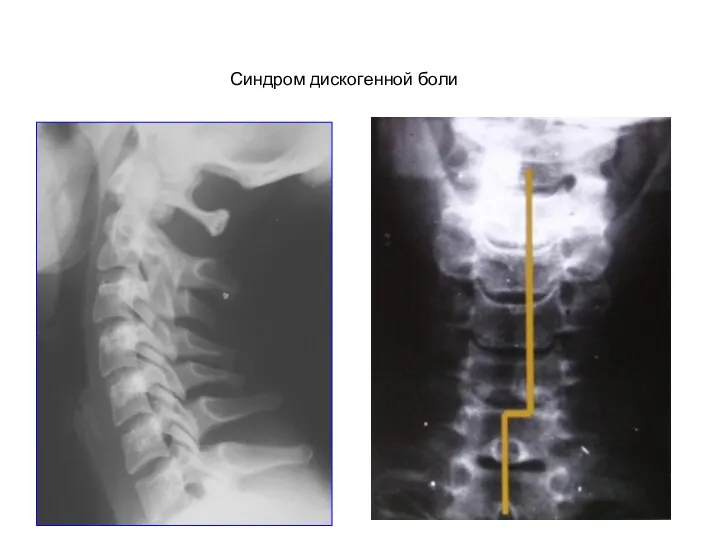Синдром дискогенной боли