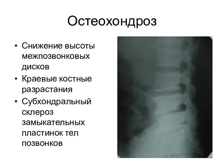 Остеохондроз Снижение высоты межпозвонковых дисков Краевые костные разрастания Субхондральный склероз замыкательных пластинок тел позвонков