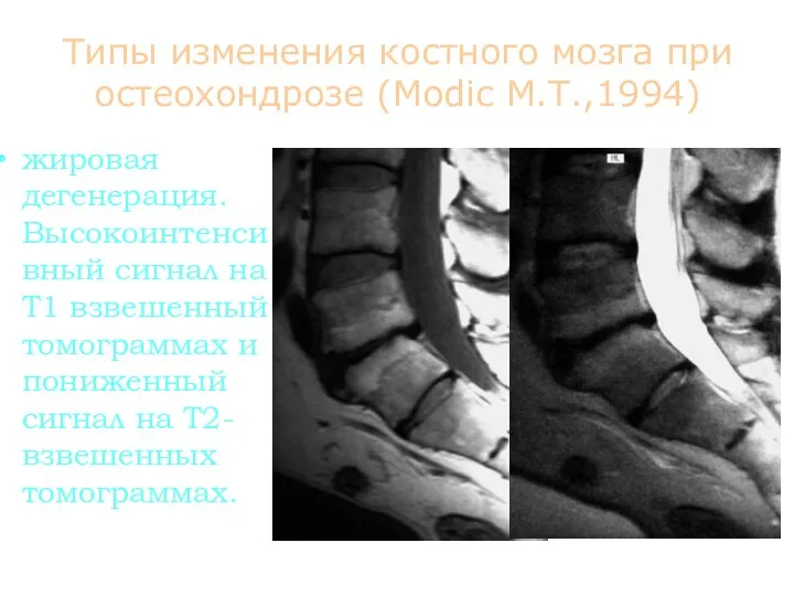 Типы изменения костного мозга при остеохондрозе (Modic M.T.,1994) жировая дегенерация. Высокоинтенсивный