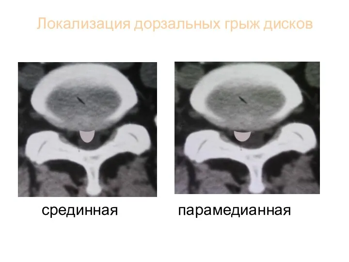 Локализация дорзальных грыж дисков срединная парамедианная